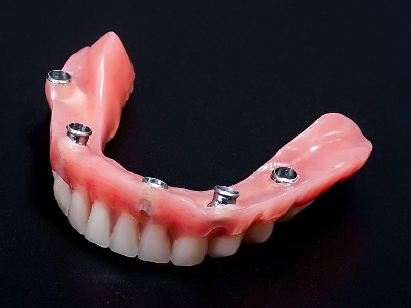 Навесной Зубной Протез