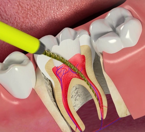 Чистка каналов зуба - Atlantis Dental