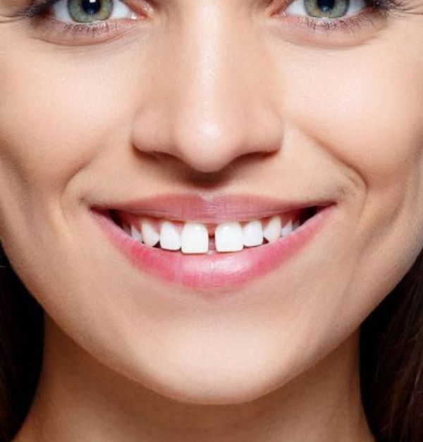 Лечение диастемы зубов - Atlantis Dental