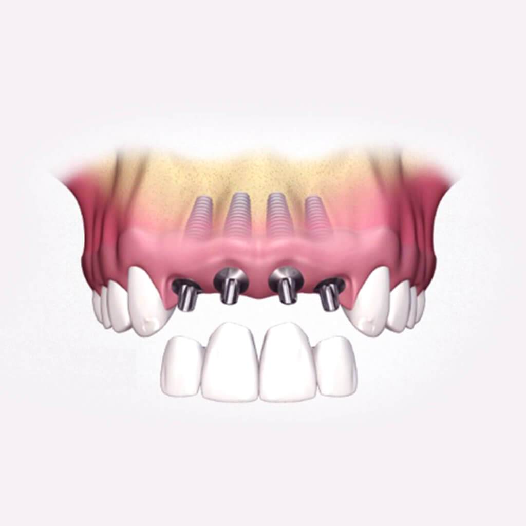 Имплантация передних зубов - Atlantis Dental
