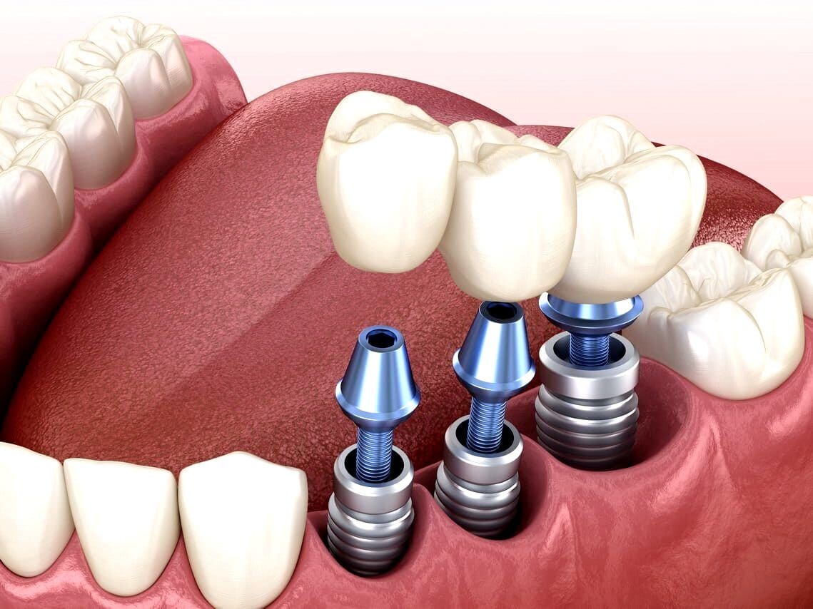 Имплантация жевательных зубов - Atlantis Dental