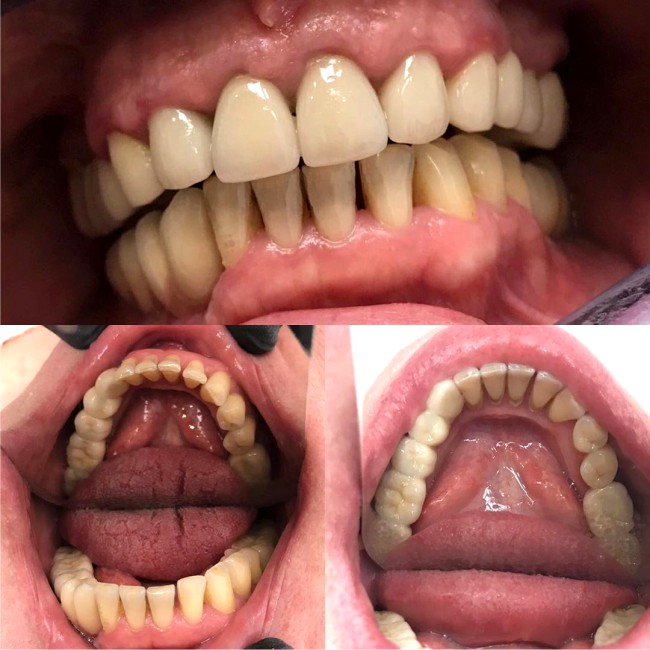 Пример имплантации зубов №1