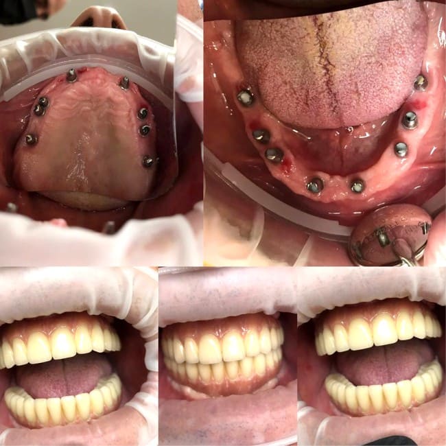 Пример имплантации зубов №2