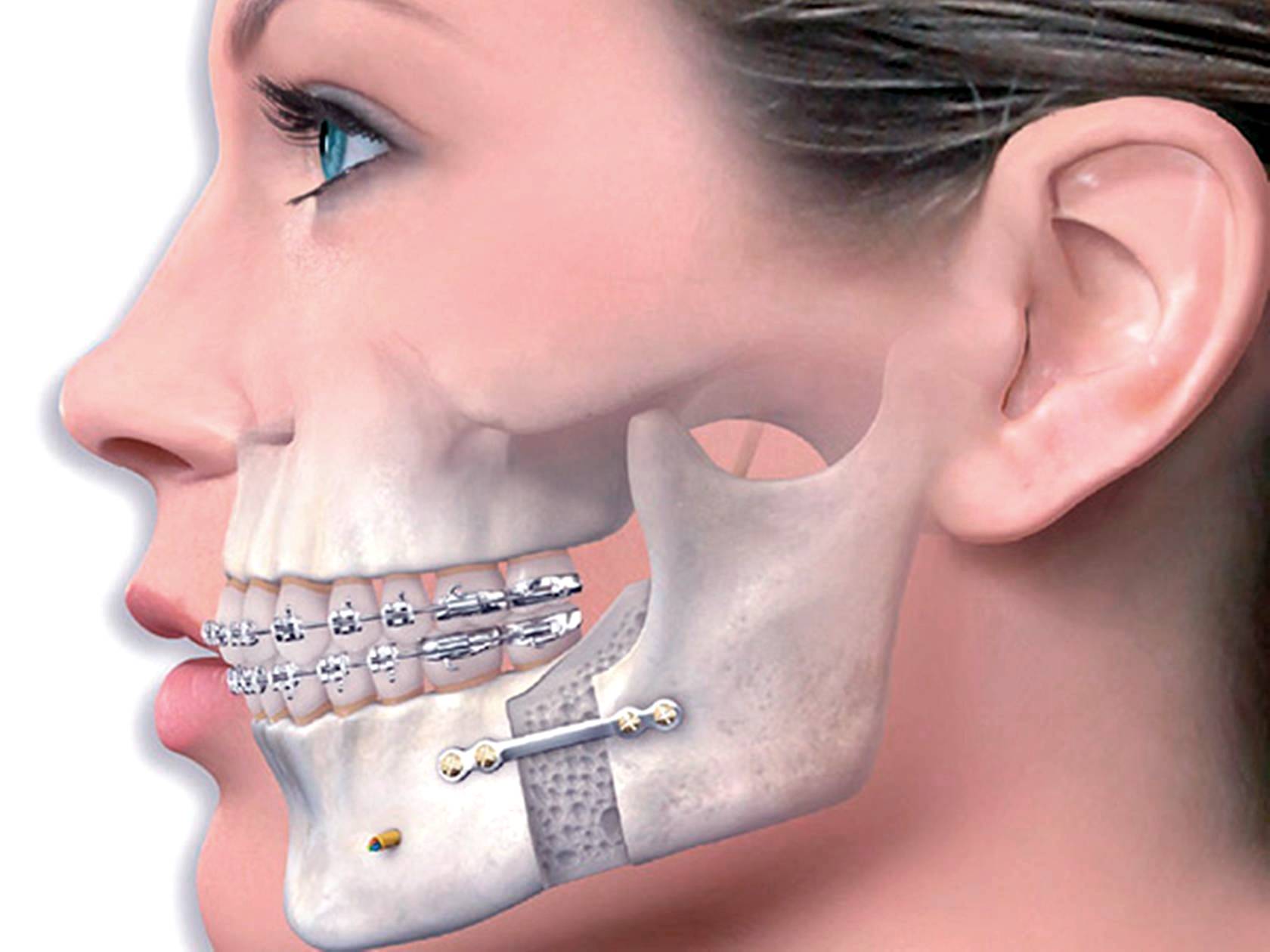 Исправление прикуса - Atlantis Dental