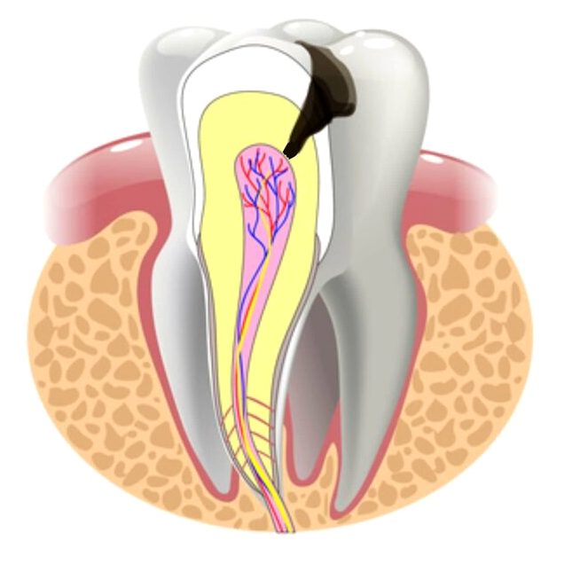 Реставрация скола зуба -  Atlantis Dental