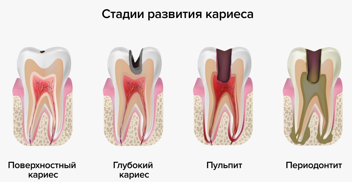 Лечение глубокого кариеса в стоматологии  Atlantis Dental