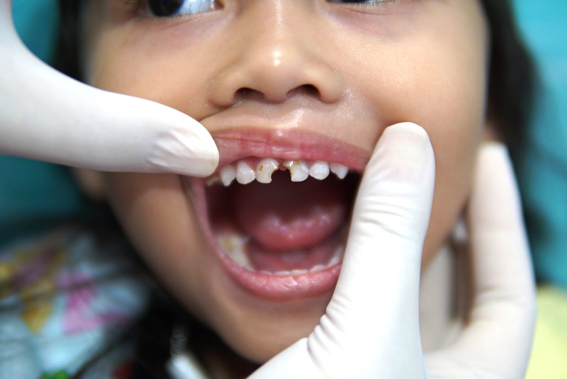 Лечение кариеса у детей - Atlantis Dental