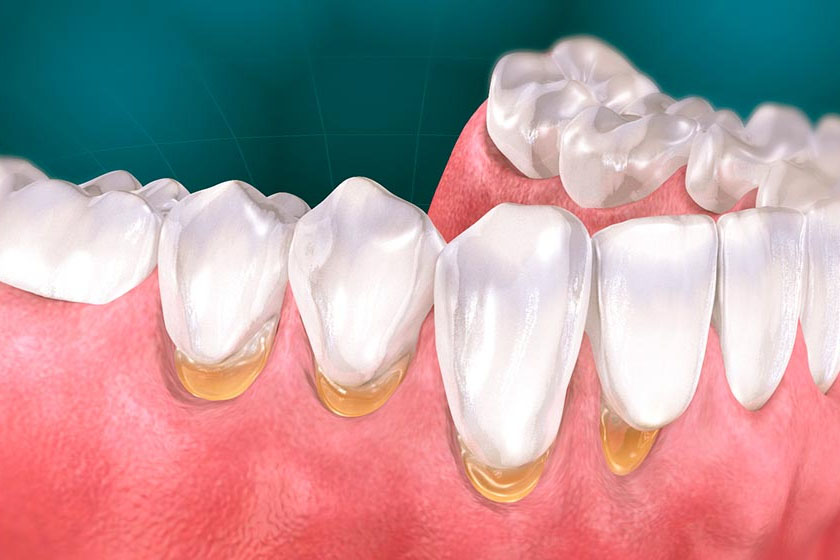 Лечение клиновидного дефекта -  Atlantis Dental