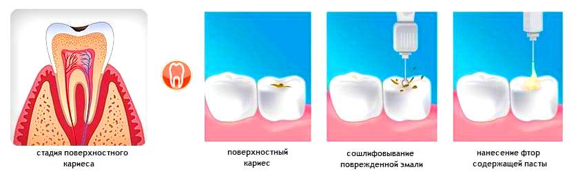 Лечение поверхностного кариеса в стоматологии  Atlantis Dental