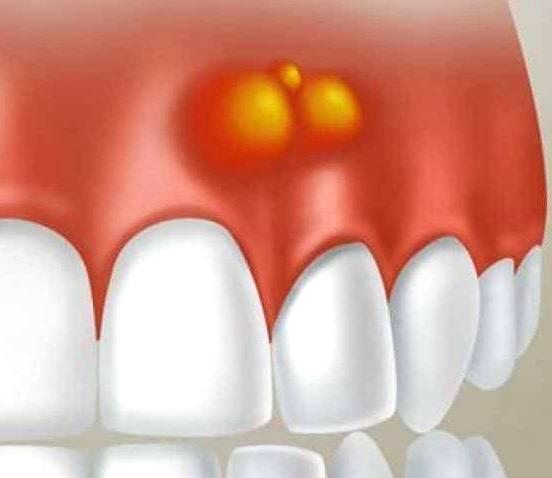 Лечение свища на десне -  стоматология Atlantis Dental
