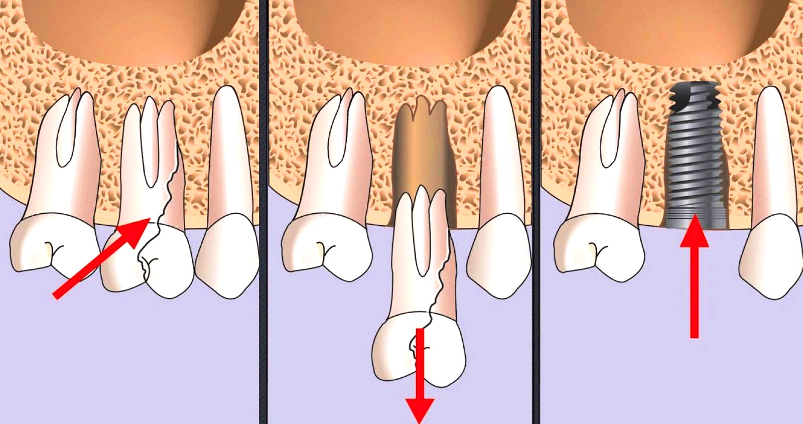 Одномоментная имплантация. Этапы - Atlantis Dental