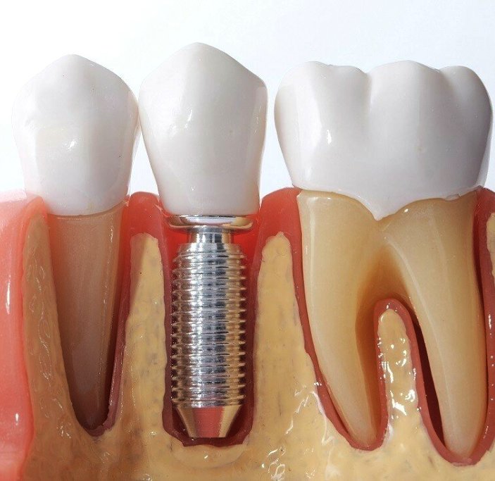 Одномоментная имплантация зубов - Atlantis Dental