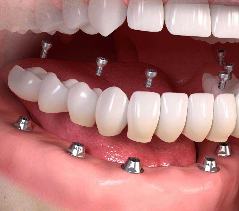Полная имплантация зубов - Atlantis Dental