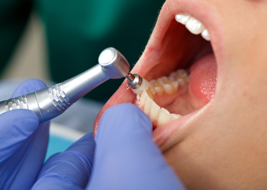 Чистка зубов у стоматолога для детей