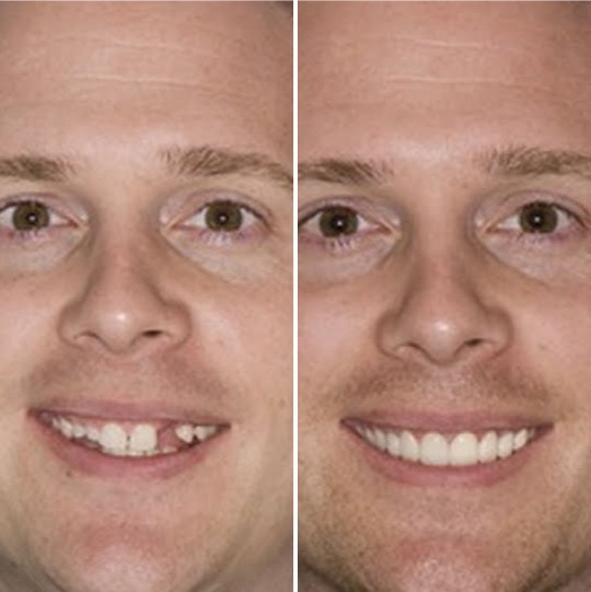 Протезирования передних зубов до и после