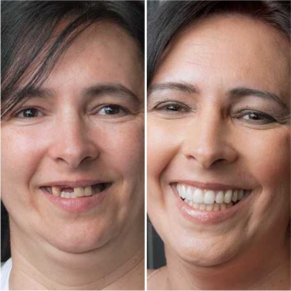 Протезирование верхних зубов до и после