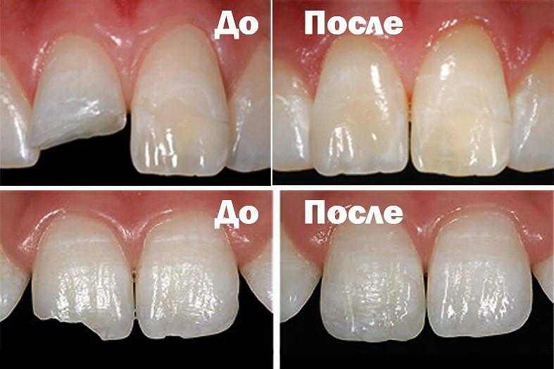 Реставрация скола зуба в стоматологии  Atlantis Dental