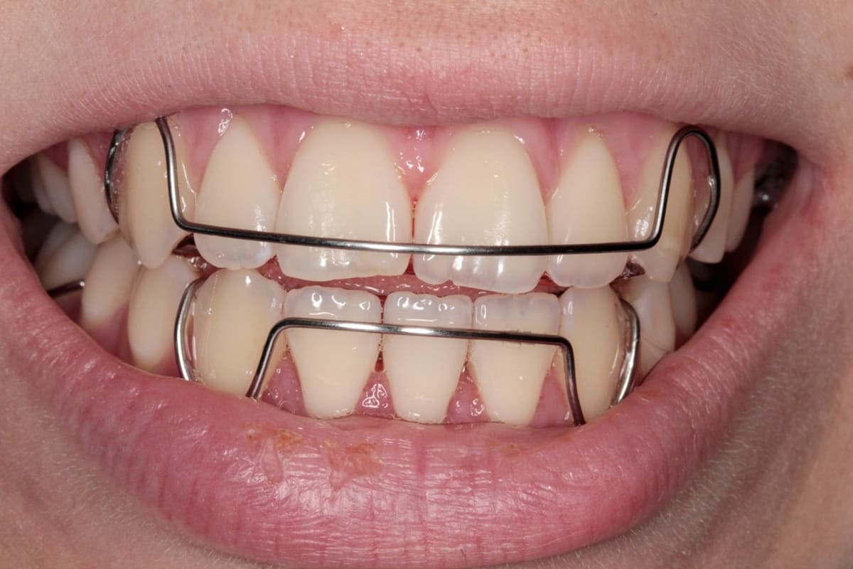 Ретейнеры для зубов - Atlantis Dental
