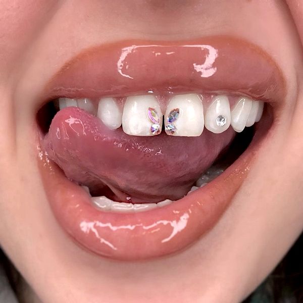 Зубные скайсы