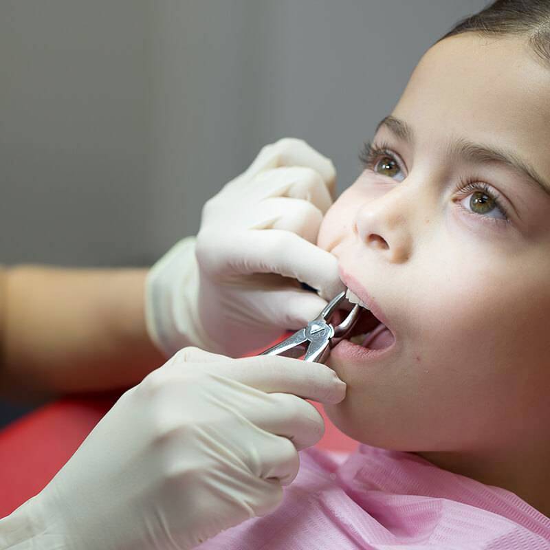 Процедура удаления молочного зуба - Atlantis Dental