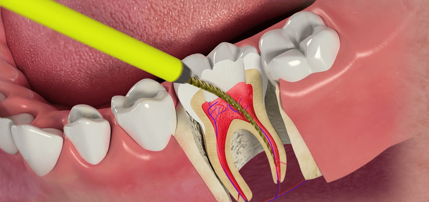 удаление нерва в зубе - Atlantis Dental