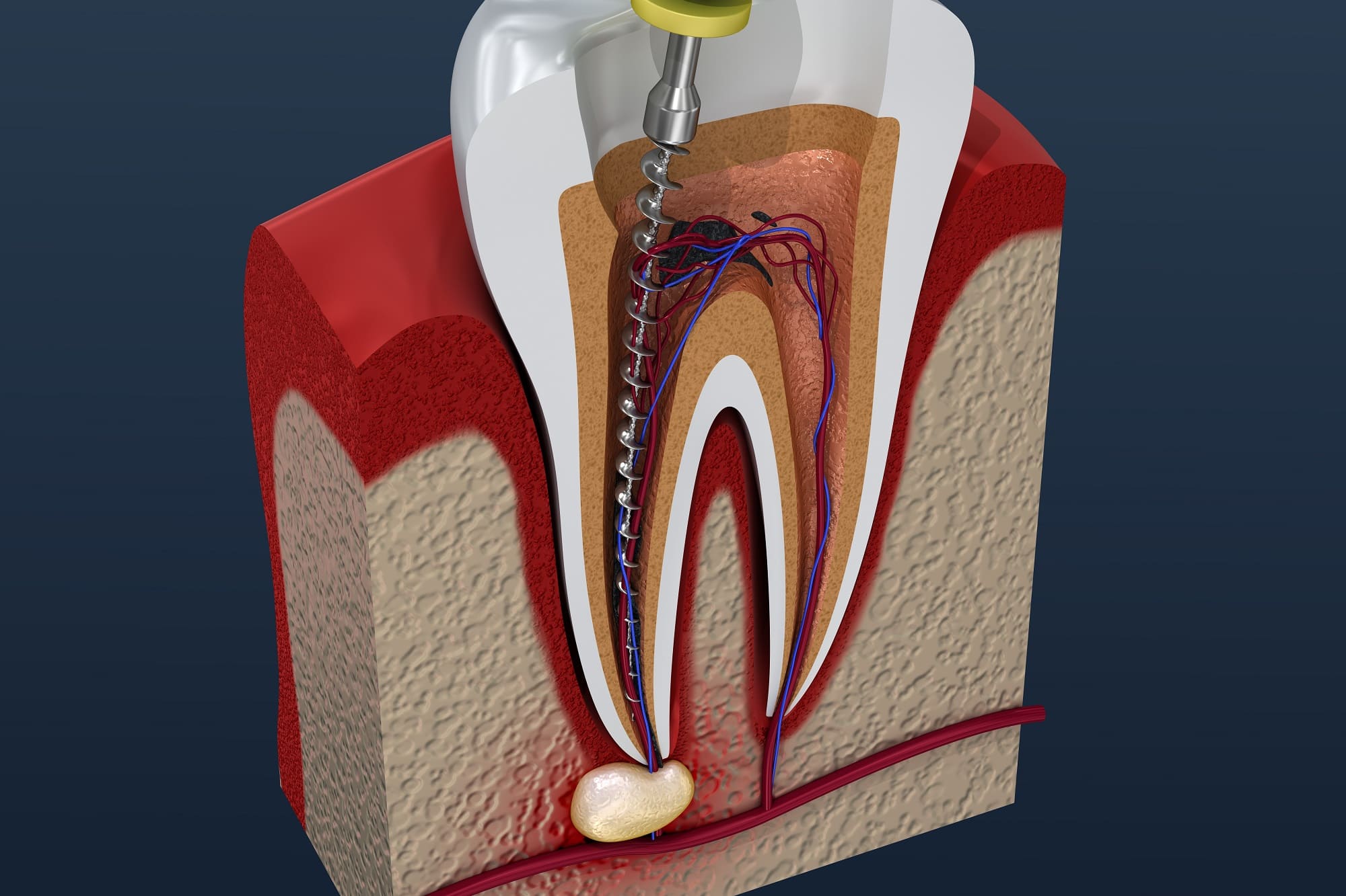 удаление зубного нерва - Atlantis Dental