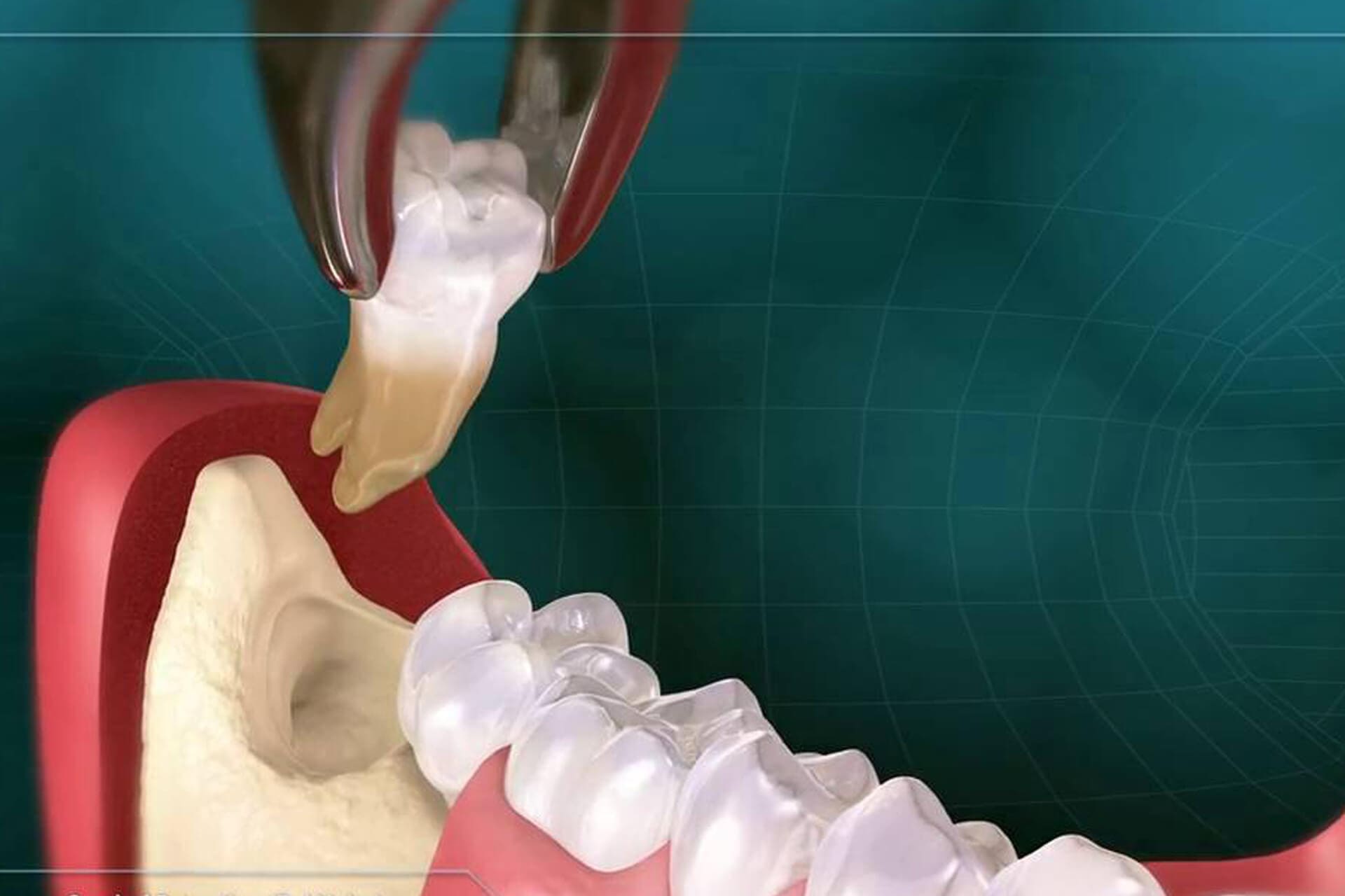 Удаление зуба мудрости на нижней челюсти - Atlantis Dental