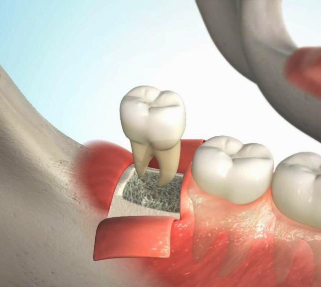 Удаление ретинированного зуба - Atlantis Dental
