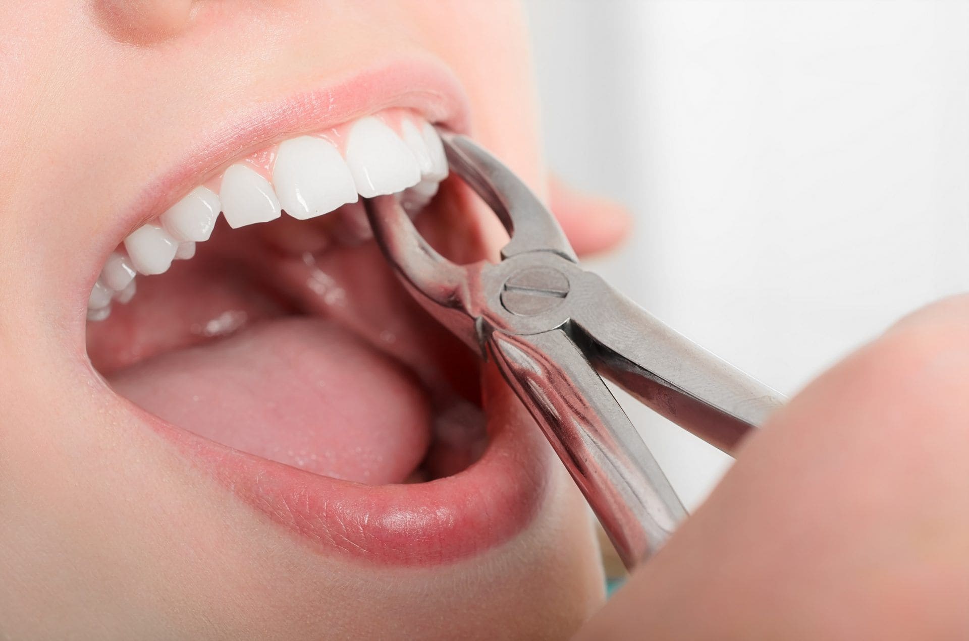 Удаление зубов на верхней челюсти - Atlantis Dental