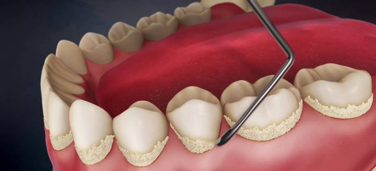 Удаление зубного камня -  Atlantis Dental