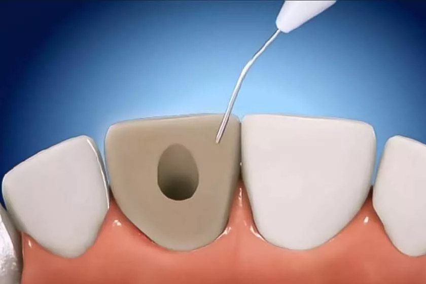 Внутриканальное отбеливание зубов - Atlantis Dental