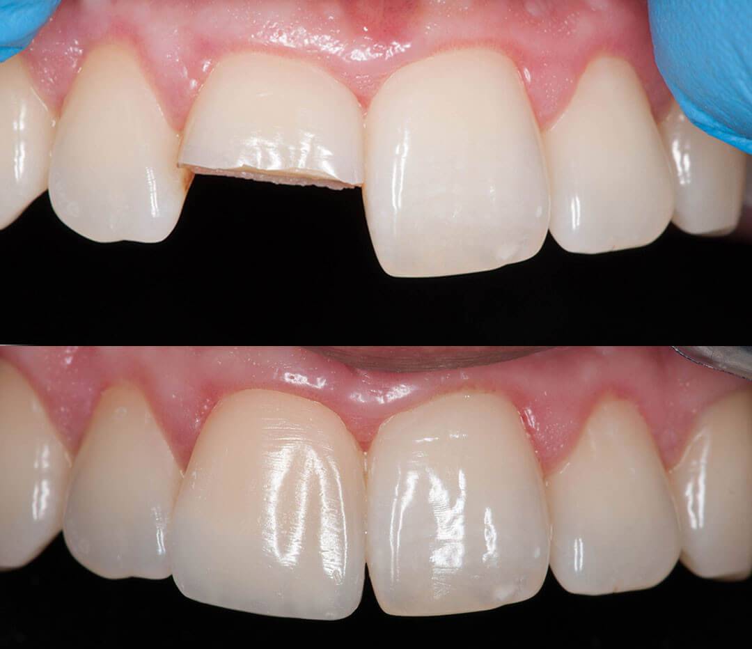 Сломанный зуб до и после лечения