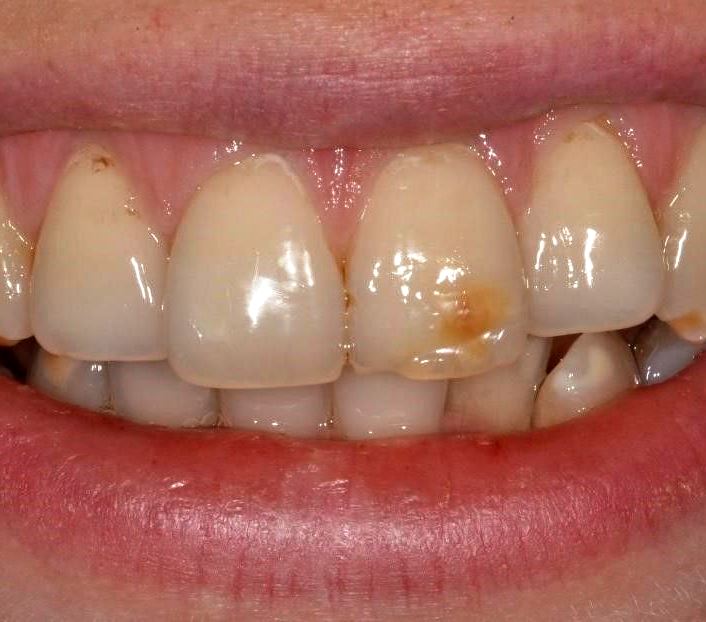 Пример флюороза зуба перед лечением
