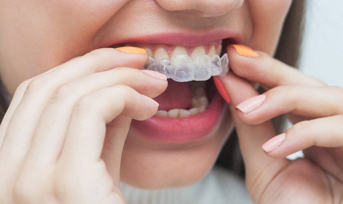 Элайнеры - Atlantis Dental