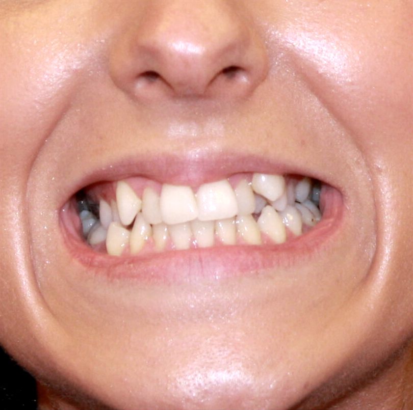 Как исправить кривые зубы - Atlantis Dental