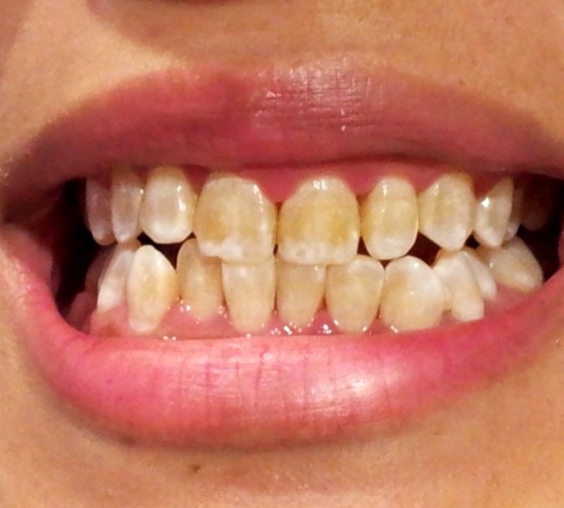 Потемнел зуб -  Atlantis Dental