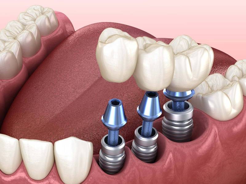 Корневидный имплант - Atlantis Dental