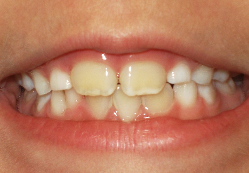 Зубы в два ряда (акульи зубы)