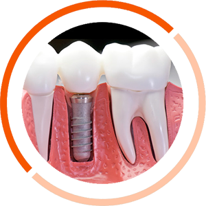 имплантация зубов под ключ в Atlantis Dental